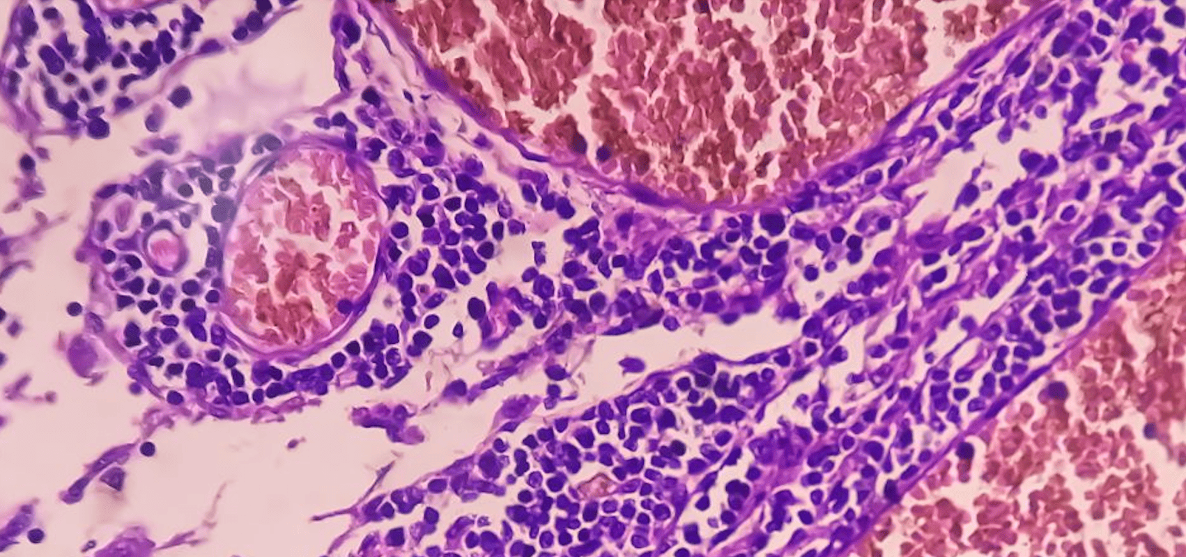 Nach der EU-Zulassung von Zolbetuximab: Wann wird das Medikament für Patienten verfügbar sein?