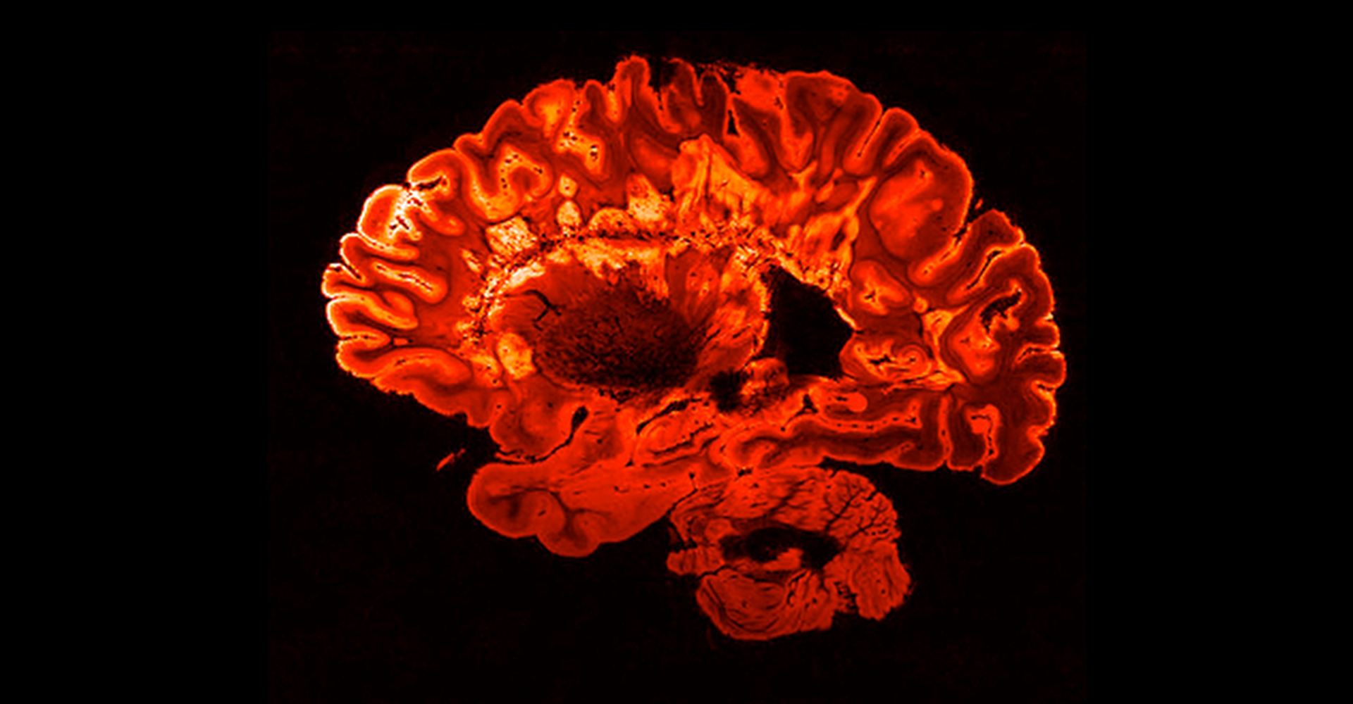 roter MRT-Gehirnscan